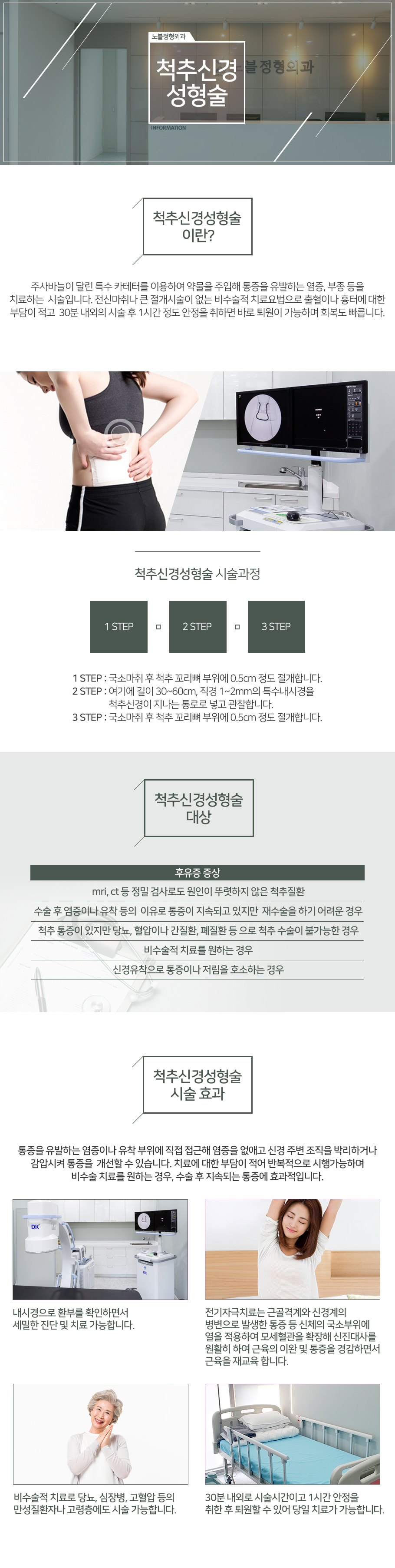 척추신경성형술